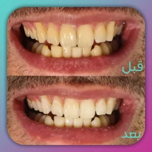 بلیچینگ دو فک 04