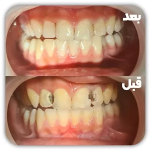 ترمیم - پر کردن چهار دندان جلو 01