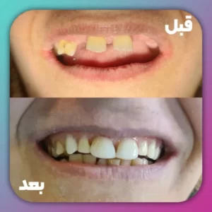 دست دندان پارسیل و کامپوزیت ونیر دو دندان جلو 01