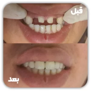 روکش دندان - بریج 01
