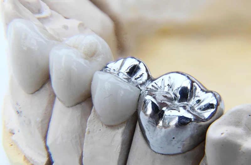 مراقبت‌های بعد از گذاشتن روکش دندان - افزایش طول عمر