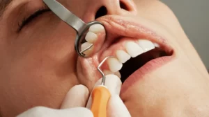 مراقبت‌های بعد از جرم گیری و بروساژ